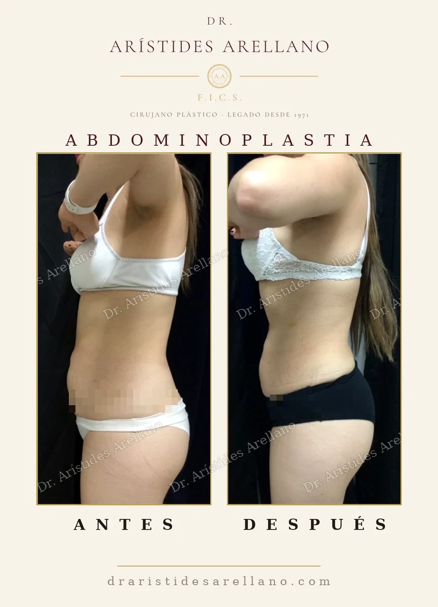 Abdominoplastia antes y después de perfil con ropa interior, cómo se ve el resultado vestida, cirugía del Dr. Arístides Arellano, cirujano plástico en Puebla