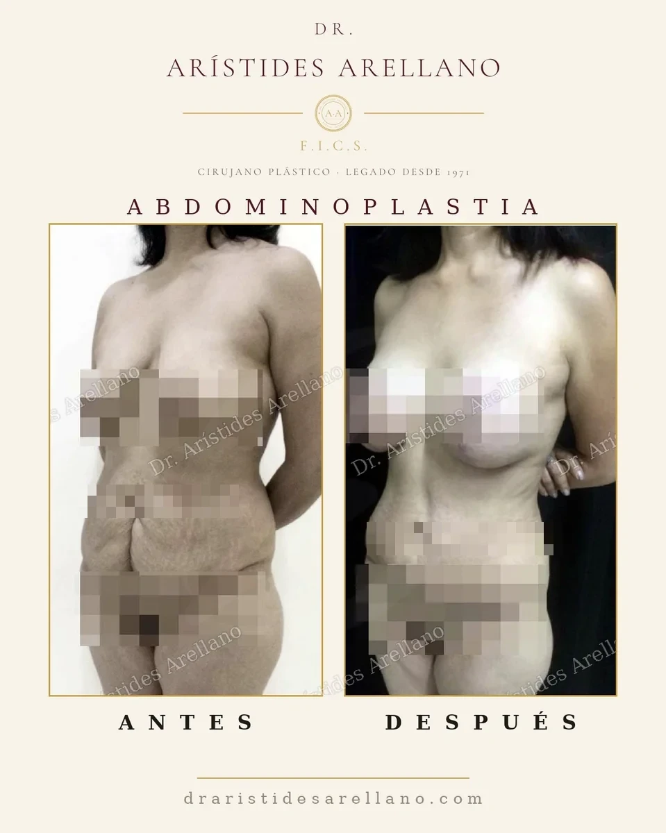 Abdominoplastia con liposucción antes y después en vista oblicua, diferencia entre retirar piel y aspirar grasa, resultado del Dr. Arístides Arellano en Puebla