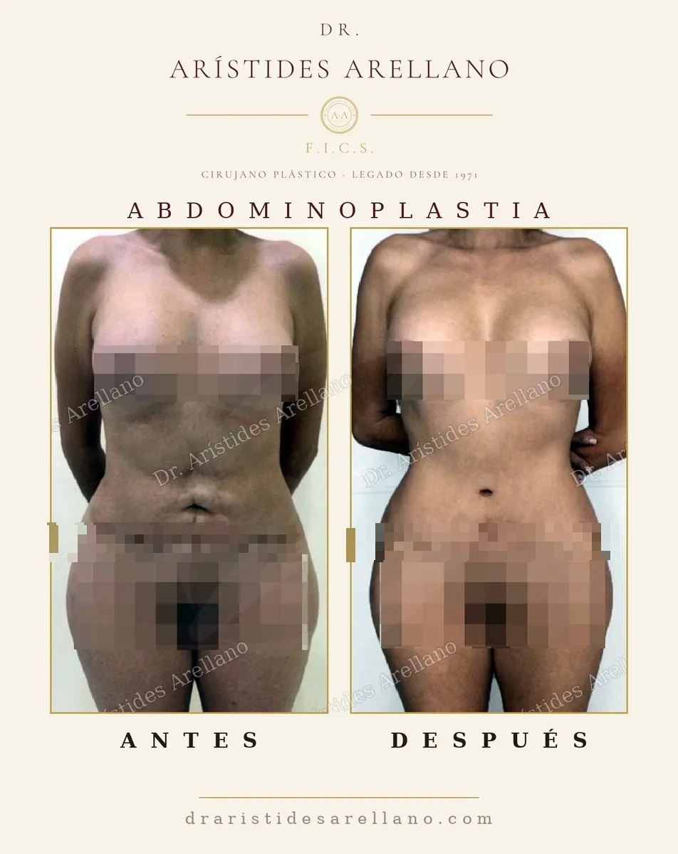 Abdominoplastia antes y después de frente: abdomen plano y ombligo reposicionado, cirugía realizada por el Dr. Arístides Arellano en Puebla