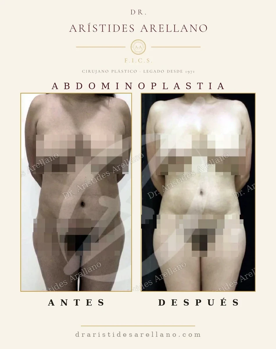 Abdominoplastia con plicatura muscular antes y después de frente, corrección de la diástasis de rectos, caso del Dr. Arístides Arellano, cirujano plástico en Puebla