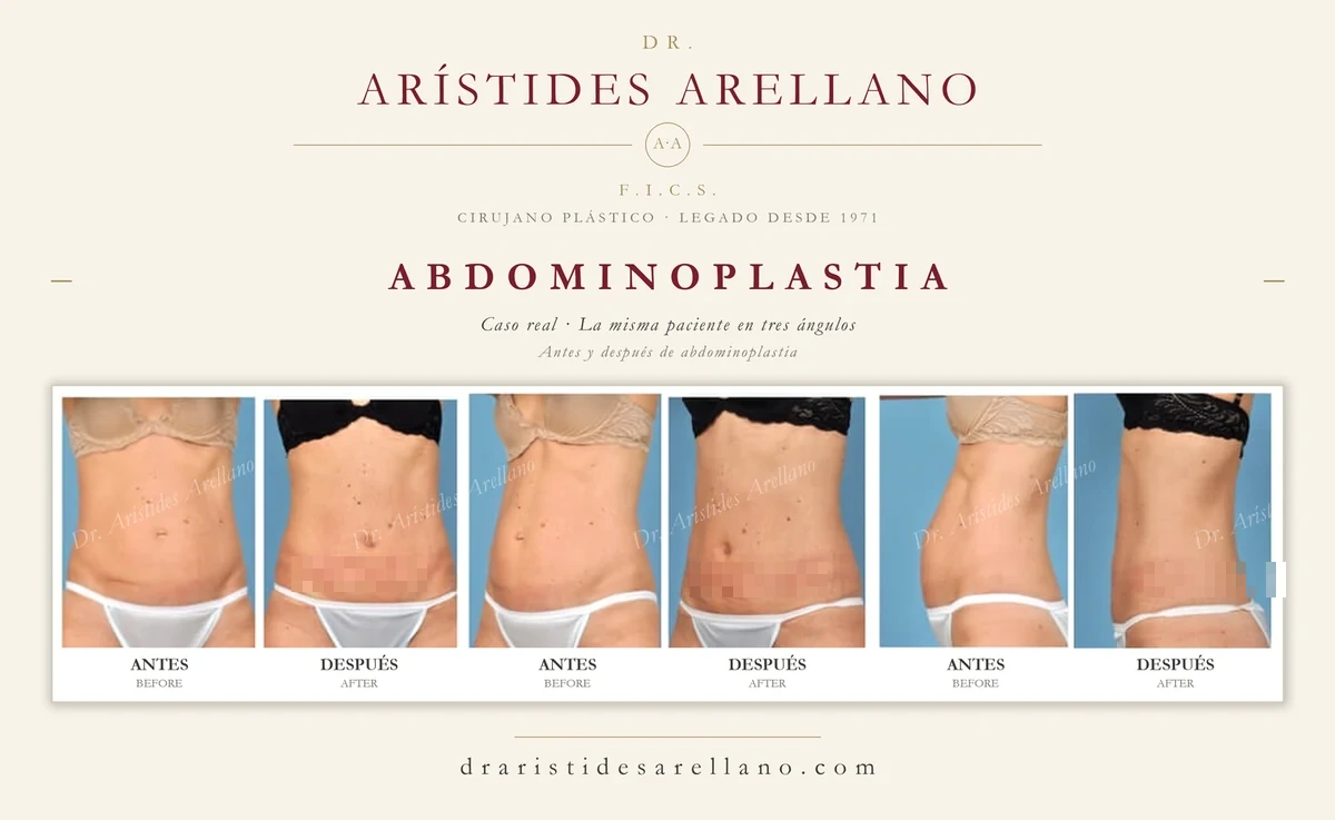 Abdominoplastia completa antes y después de frente, diferencia frente a la mini-abdominoplastia, cirugía del Dr. Arístides Arellano, cirujano plástico en Puebla