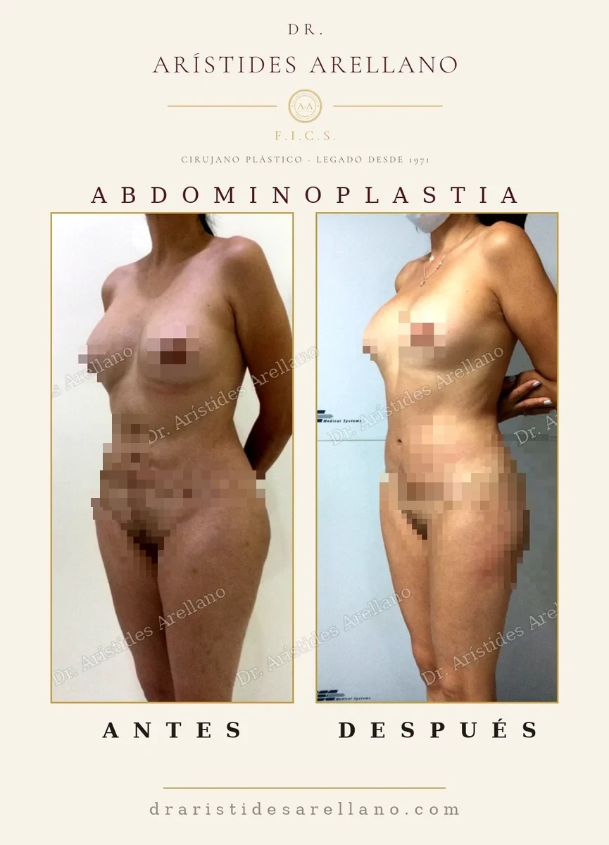 Abdominoplastia antes y después en vistas frontal y oblicua, abdomen plano tras retirar la piel sobrante, caso real del Dr. Arístides Arellano, cirujano plástico en Puebla