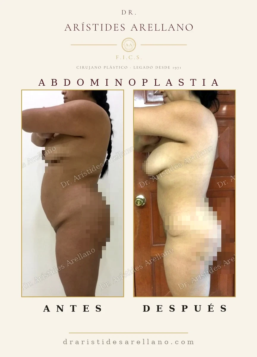 Abdominoplastia antes y después de perfil: reducción del delantal abdominal y recuperación del contorno de la cintura, cirugía del Dr. Arístides Arellano en Puebla