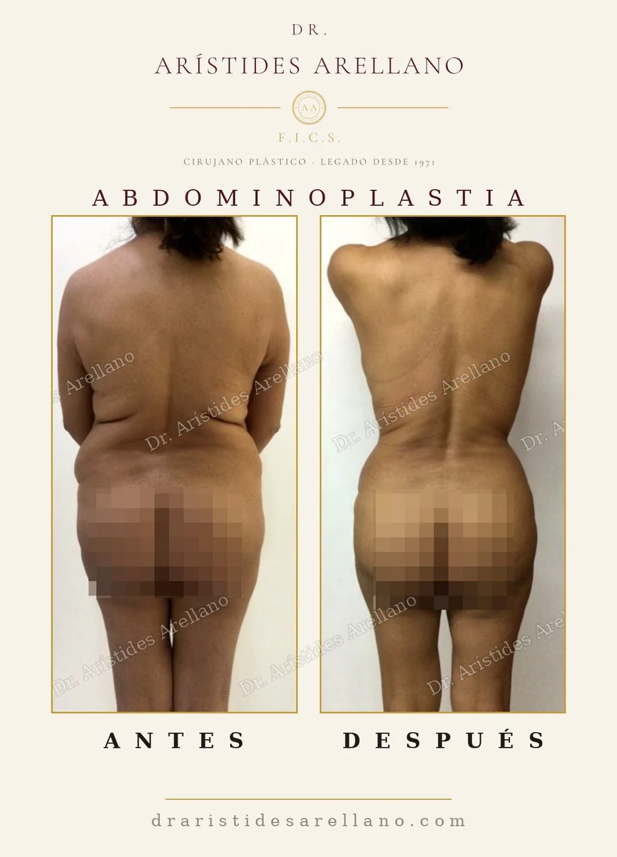 Abdominoplastia antes y después vista de espalda: corrección de los rollos laterales y de la cintura, resultado real del Dr. Arístides Arellano, cirujano plástico en Puebla