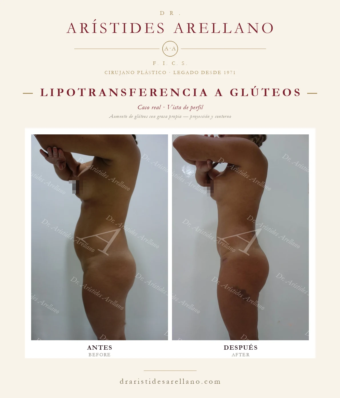Aumento de glúteos BBL con grasa propia — antes y después de perfil, proyección y contorno glúteo, caso real del Dr. Arístides Arellano en Puebla