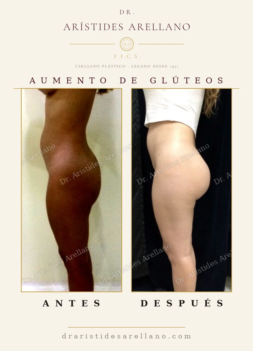 Aumento de glúteos BBL antes y después, resultado estable tras la reabsorción de la grasa injertada, caso del Dr. Arístides Arellano en Puebla
