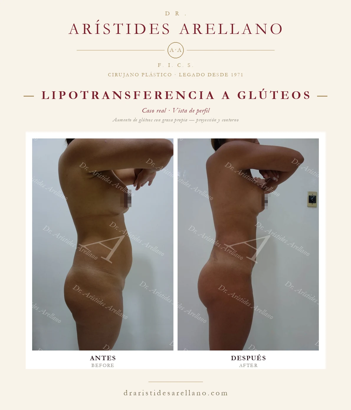 Aumento de glúteos con grasa propia (BBL) — antes y después de perfil, cintura y proyección glútea, caso real del Dr. Arístides Arellano en Puebla