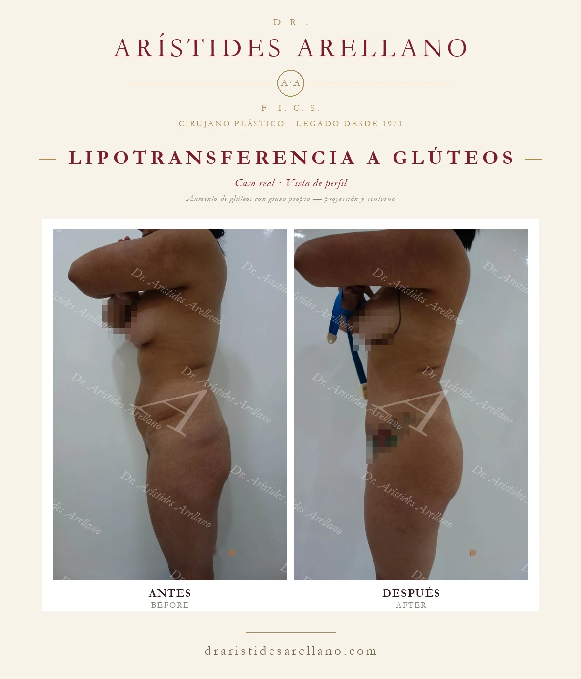 BBL — aumento de glúteos con lipotransferencia, antes y después de perfil, caso real del Dr. Arístides Arellano en Puebla