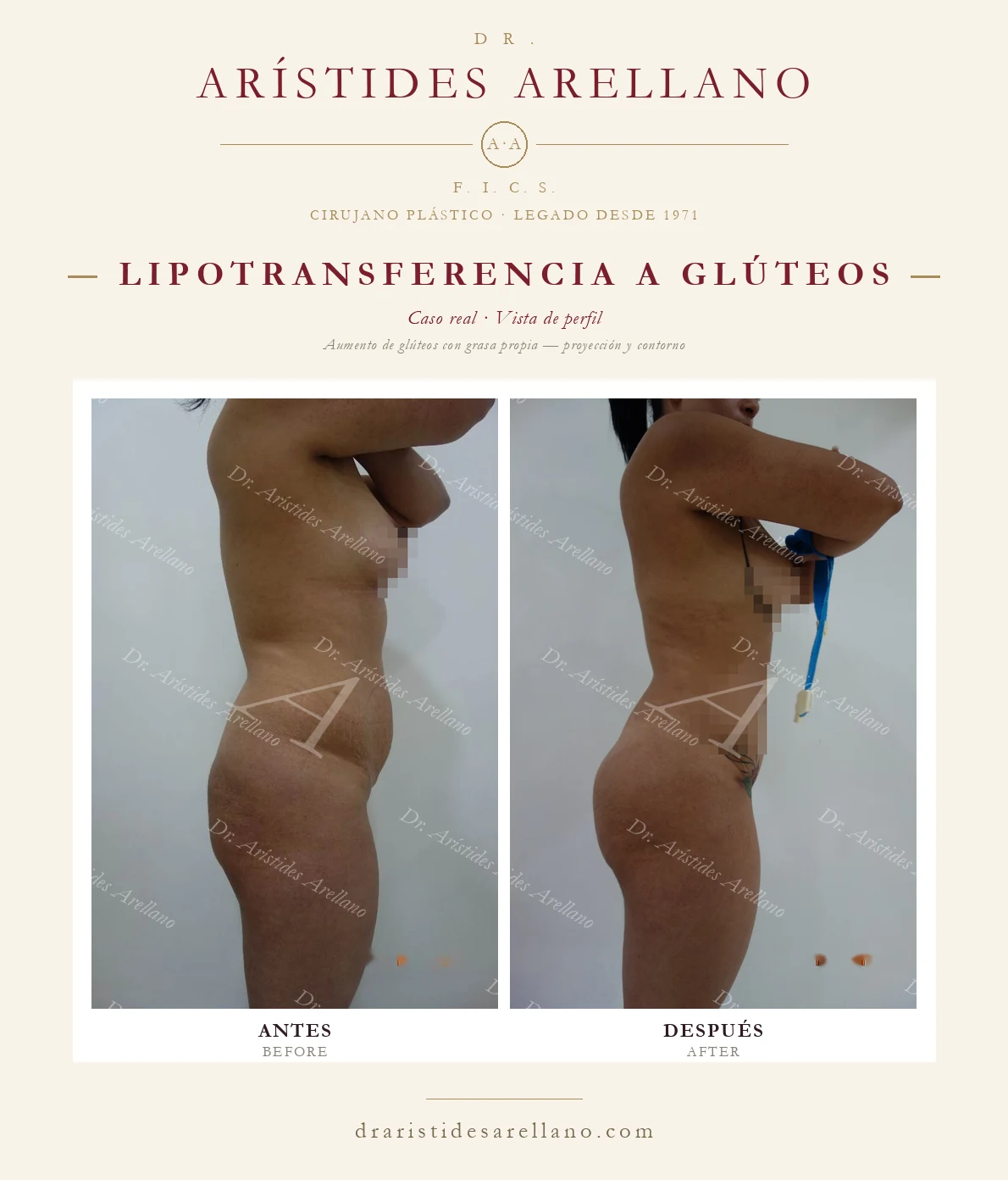 Aumento de glúteos BBL — antes y después de perfil, contorno de cintura y glúteo, caso real del Dr. Arístides Arellano en Puebla