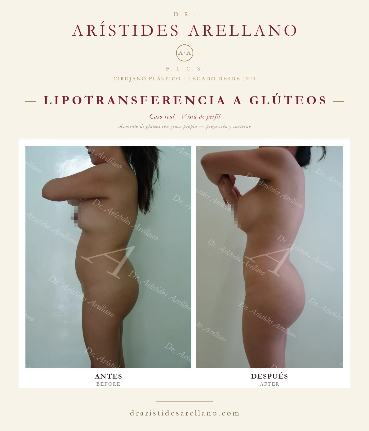 Aumento de glúteos con grasa propia — antes y después de perfil, proyección glútea y silueta, caso real del Dr. Arístides Arellano en Puebla