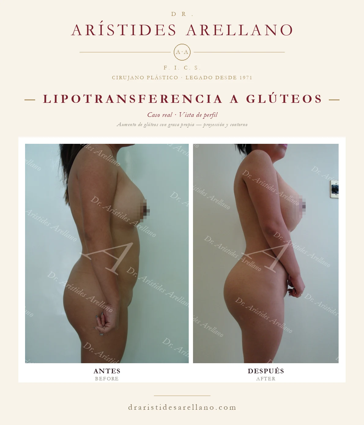 BBL en Puebla — aumento de glúteos con lipotransferencia, antes y después de perfil, caso real del Dr. Arístides Arellano