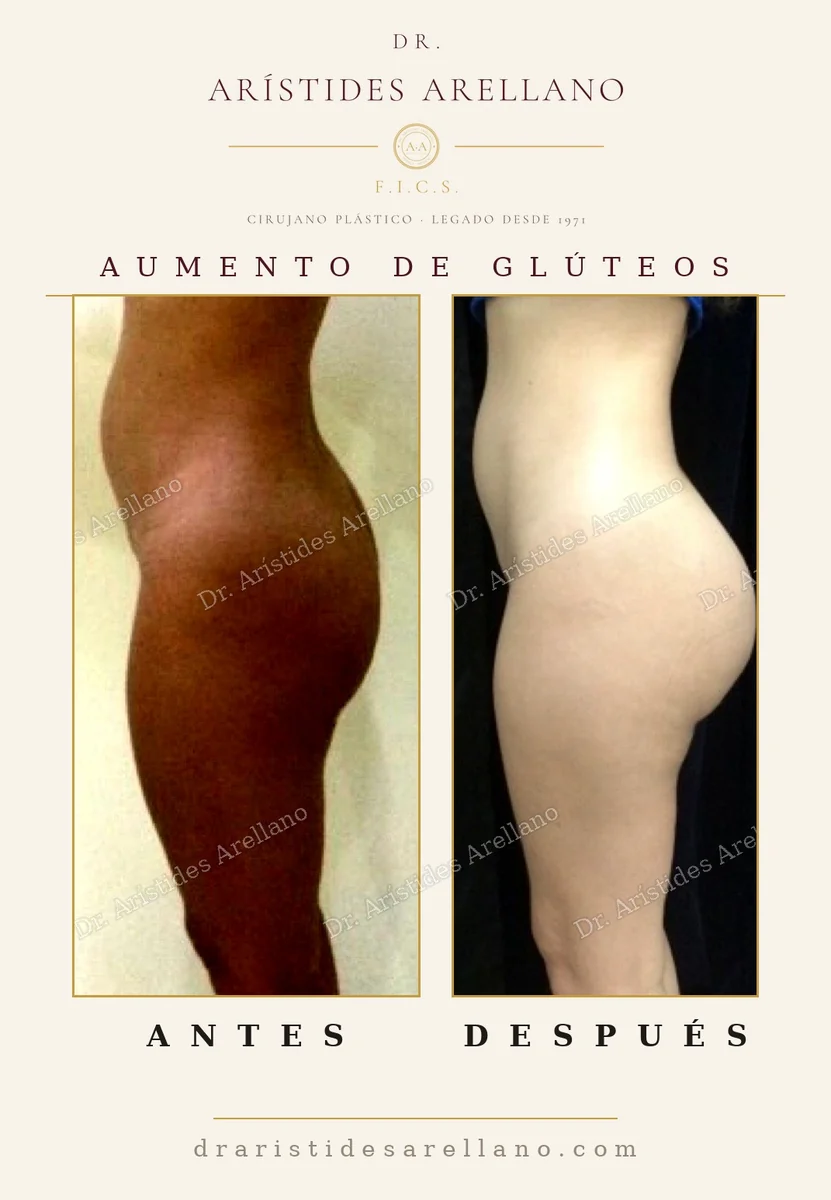 Aumento de glúteos con grasa propia antes y después, cambio de contorno de cintura y cadera, cirugía del Dr. Arístides Arellano en Puebla