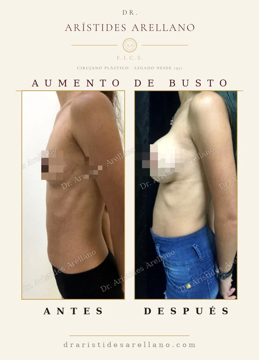 Aumento de busto antes y después de perfil, proyección lograda con implante mamario, resultado del Dr. Arístides Arellano en Puebla