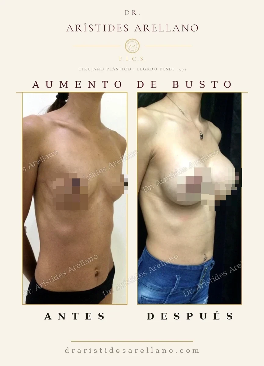 Aumento de senos antes y después en vista oblicua, evolución del postoperatorio, cirugía del Dr. Arístides Arellano, cirujano plástico en Puebla