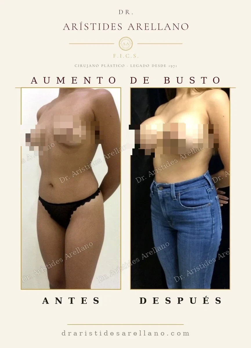 Aumento mamario antes y después en vista oblicua, resultado estable a largo plazo, caso del Dr. Arístides Arellano, cirujano plástico en Puebla