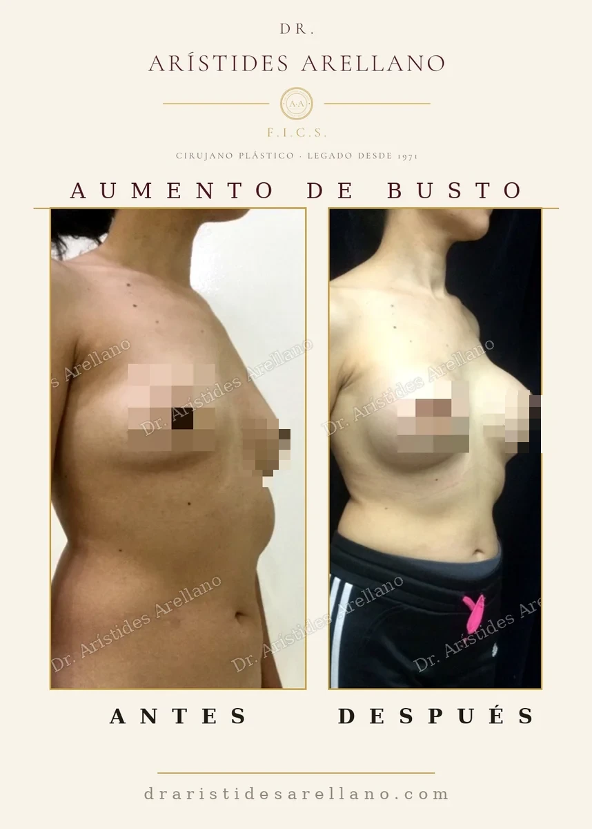 Aumento de busto antes y después de perfil, elección del tamaño del implante en centímetros cúbicos, cirugía del Dr. Arístides Arellano en Puebla