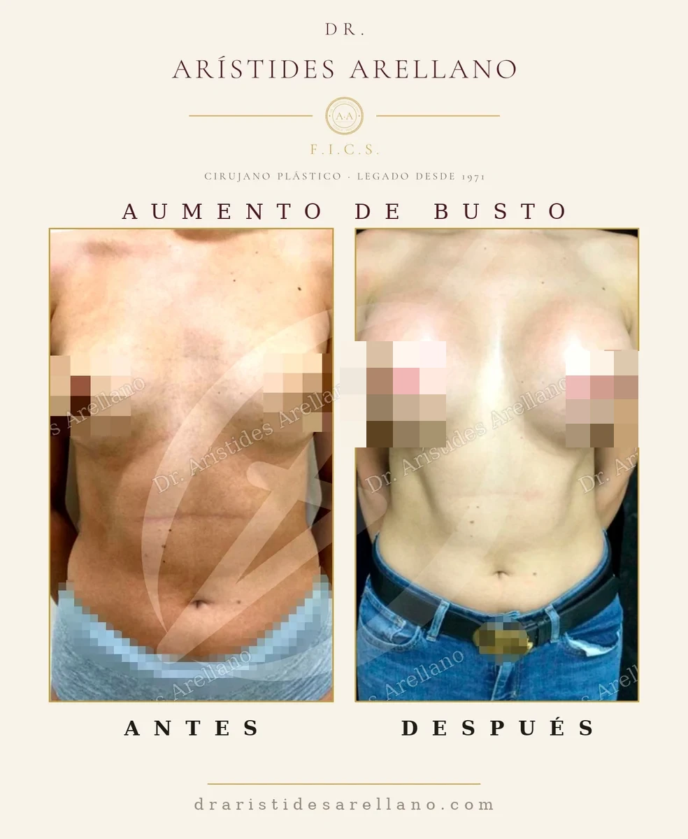 Aumento de senos antes y después de frente con implantes de gel cohesivo, resultado real del Dr. Arístides Arellano, cirujano plástico en Puebla