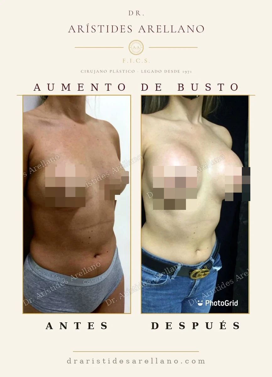 Aumento de busto antes y después en vista oblicua, implante colocado en plano submuscular, resultado del Dr. Arístides Arellano en Puebla