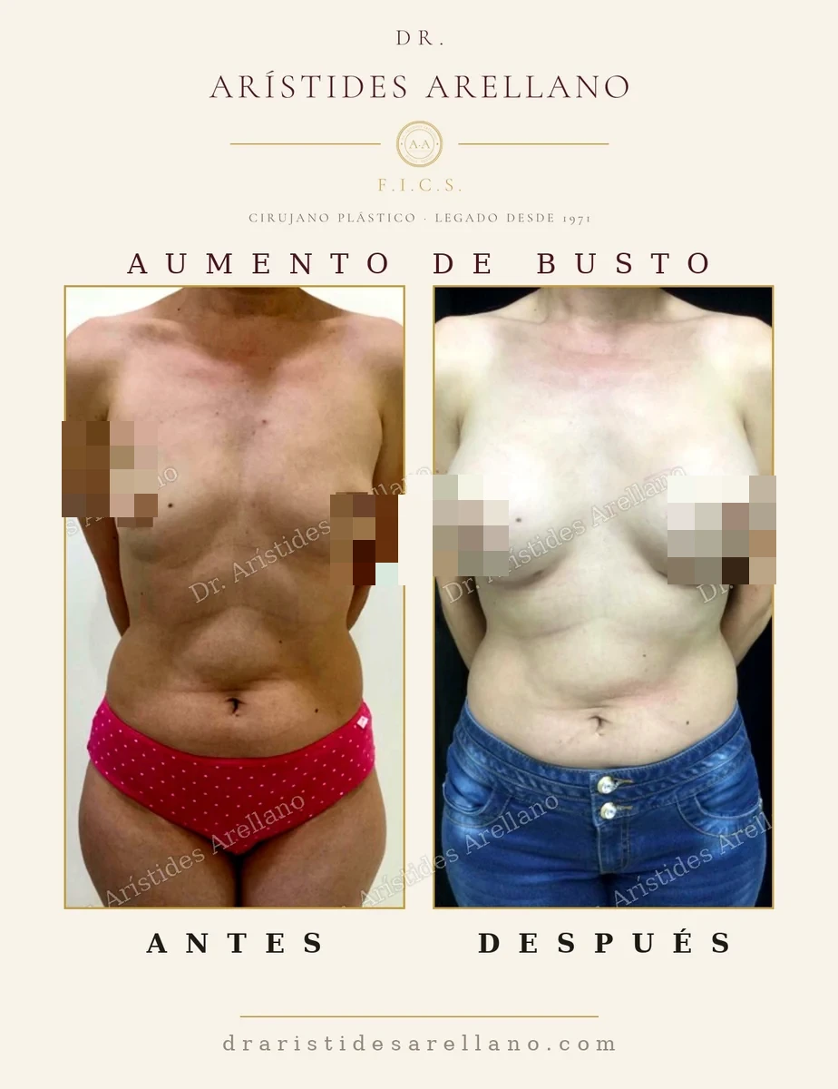 Aumento mamario antes y después de frente con perfil moderado, resultado de aspecto natural, cirugía del Dr. Arístides Arellano en Puebla
