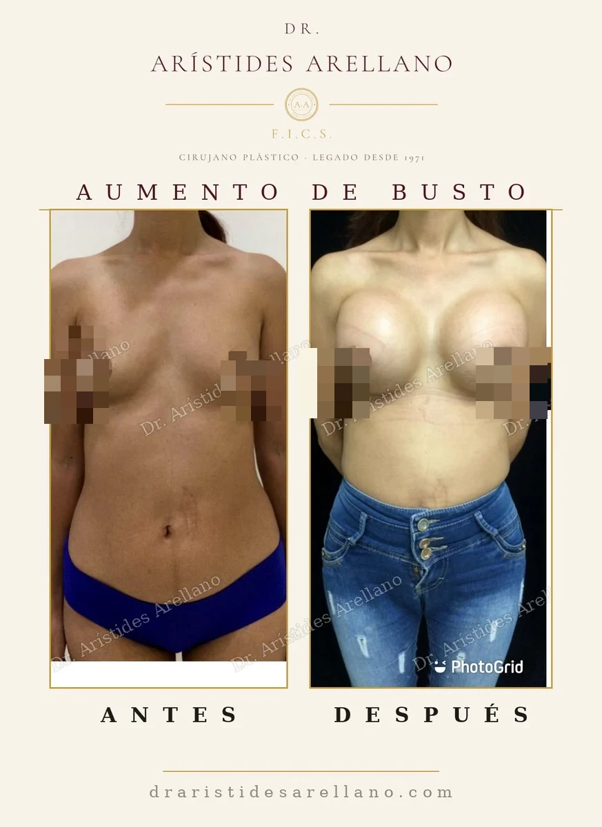 Aumento de busto antes y después de frente, correspondencia entre centímetros cúbicos y talla final, resultado del Dr. Arístides Arellano, cirujano plástico en Puebla