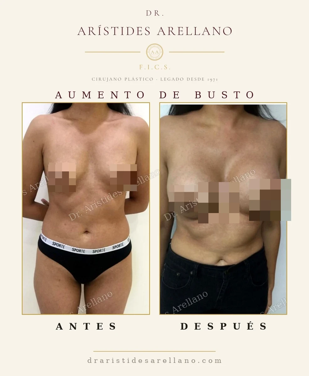 Aumento de senos antes y después de frente en pecho con descenso leve, cuándo hace falta añadir pexia, caso del Dr. Arístides Arellano en Puebla