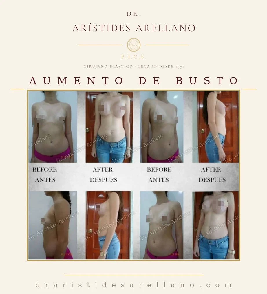 Aumento mamario — antes y después en múltiples ángulos, resultados naturales con implantes avalados por COFEPRIS, Dr. Arístides Arellano en Puebla