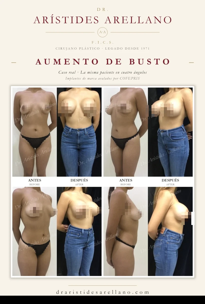 Aumento de busto — antes y después de la misma paciente en cuatro ángulos (frontal, oblicua y perfil), caso real del Dr. Arístides Arellano en Puebla; implantes de marca avalados por COFEPRIS