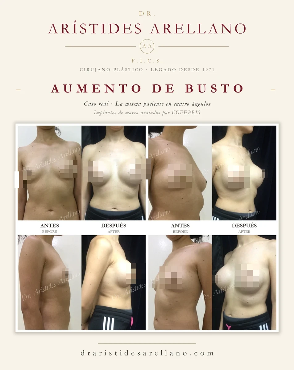 Aumento de busto — antes y después de la misma paciente en cuatro ángulos, caso real del Dr. Arístides Arellano en Puebla; implantes de marca avalados por COFEPRIS