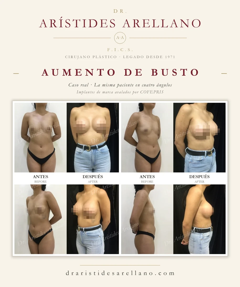Aumento de busto — antes y después de la misma paciente en cuatro ángulos (frontal, oblicuas y perfil), caso real del Dr. Arístides Arellano en Puebla; implantes de marca avalados por COFEPRIS
