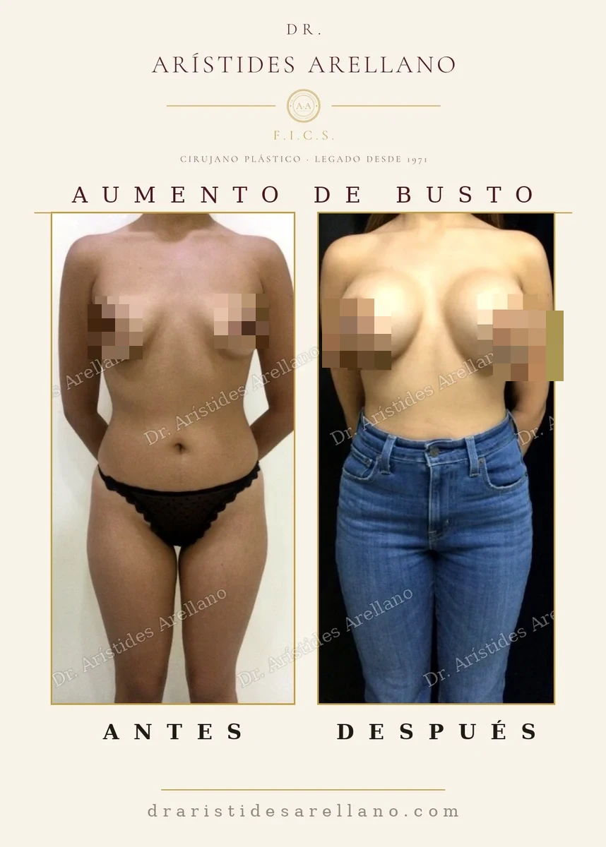 Aumento de senos con implantes antes y después de frente, cambio de volumen y proyección, caso real del Dr. Arístides Arellano, cirujano plástico en Puebla