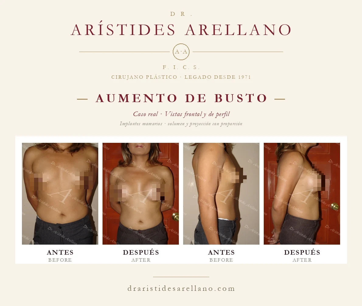 Aumento de busto con implantes — antes y después en vistas frontal y de perfil, caso real del Dr. Arístides Arellano, cirujano plástico en Puebla