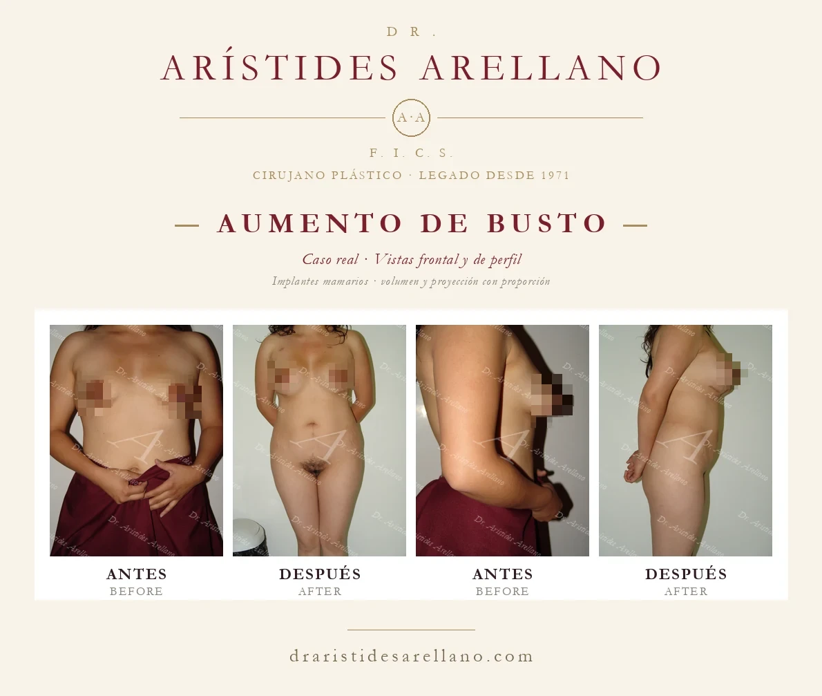Aumento de busto con implantes — antes y después en vistas frontal y de perfil, caso real del Dr. Arístides Arellano, cirujano plástico en Puebla