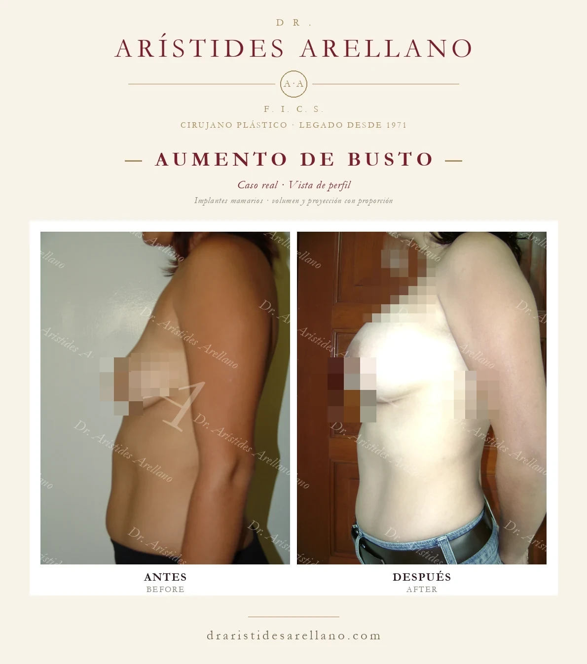 Aumento de busto con implantes — antes y después en vista de perfil, caso real del Dr. Arístides Arellano, cirujano plástico en Puebla