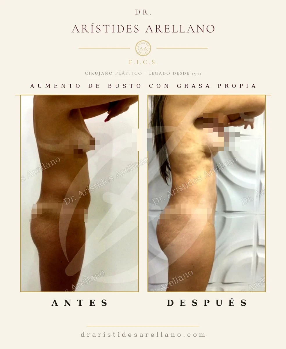 Aumento de busto con grasa propia antes y después, lipotransferencia a senos sin implantes, resultado del Dr. Arístides Arellano, cirujano plástico en Puebla