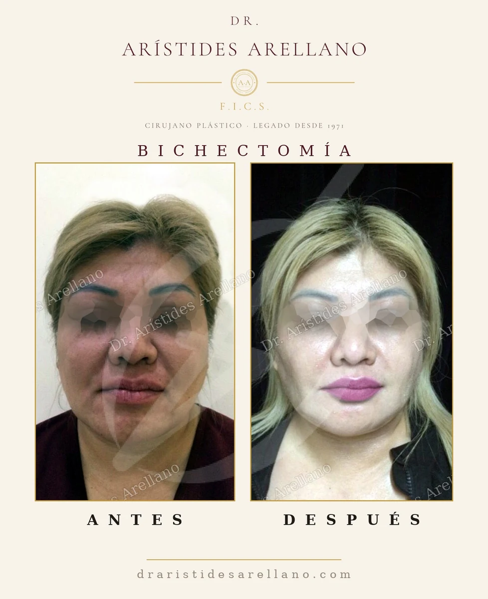 Bichectomía (retiro de bolas de Bichat) — antes y después, resultado real del Dr. Arístides Arellano, cirujano plástico en Puebla