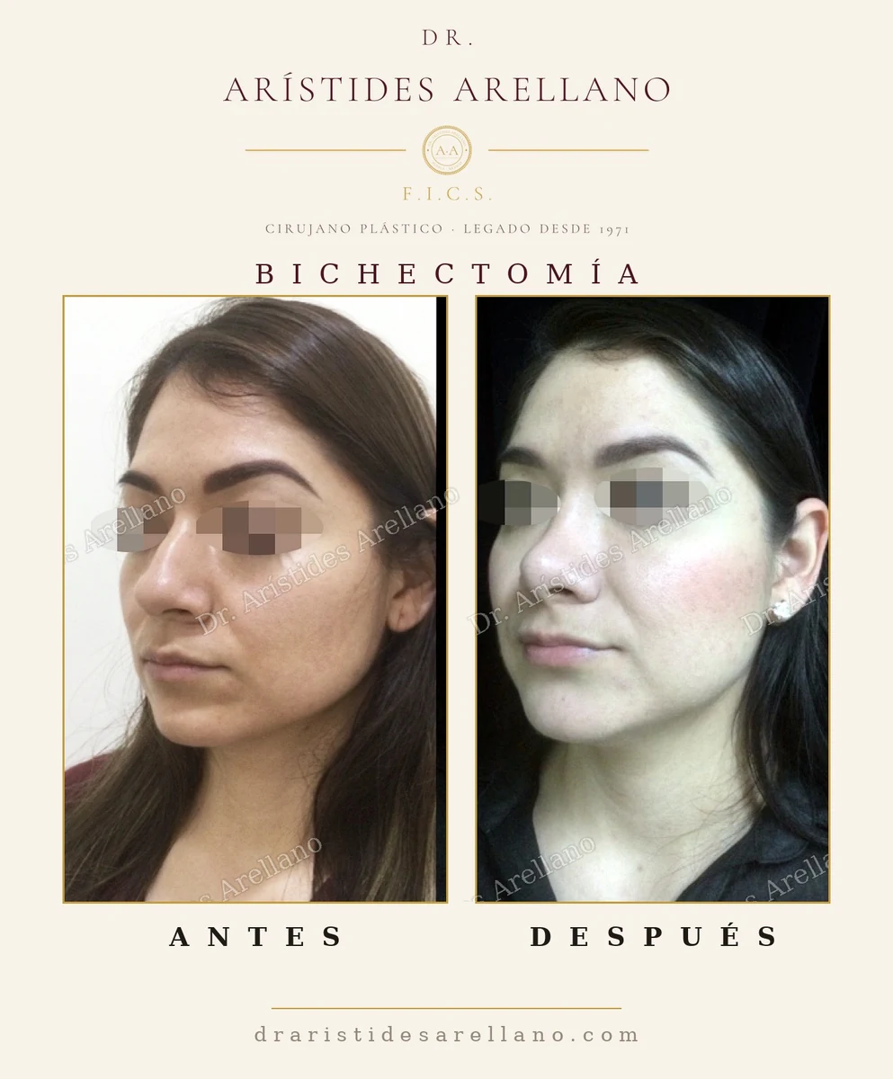 Bichectomía en mujer joven, vista de tres cuartos: definición del tercio medio del rostro — antes y después con el Dr. Arístides Arellano en Puebla