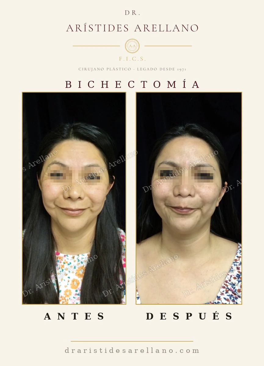 Bichectomía, vista frontal: mejillas afinadas conservando la expresión — antes y después, cirugía del Dr. Arístides Arellano en Puebla