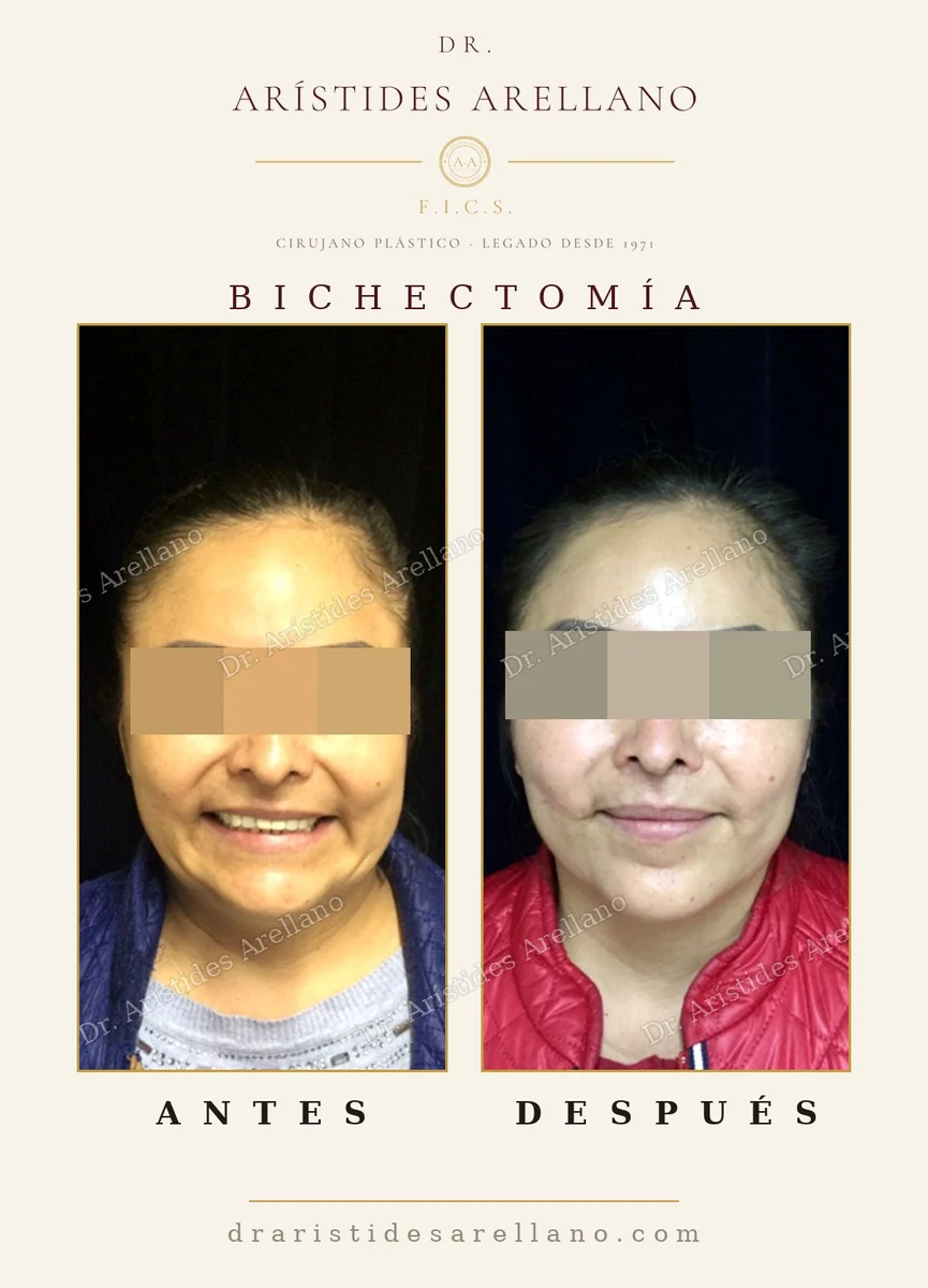 Bichectomía antes y después, afinamiento del tercio inferior de la cara por retiro de las bolas de Bichat, caso real del Dr. Arístides Arellano, cirujano plástico en Puebla
