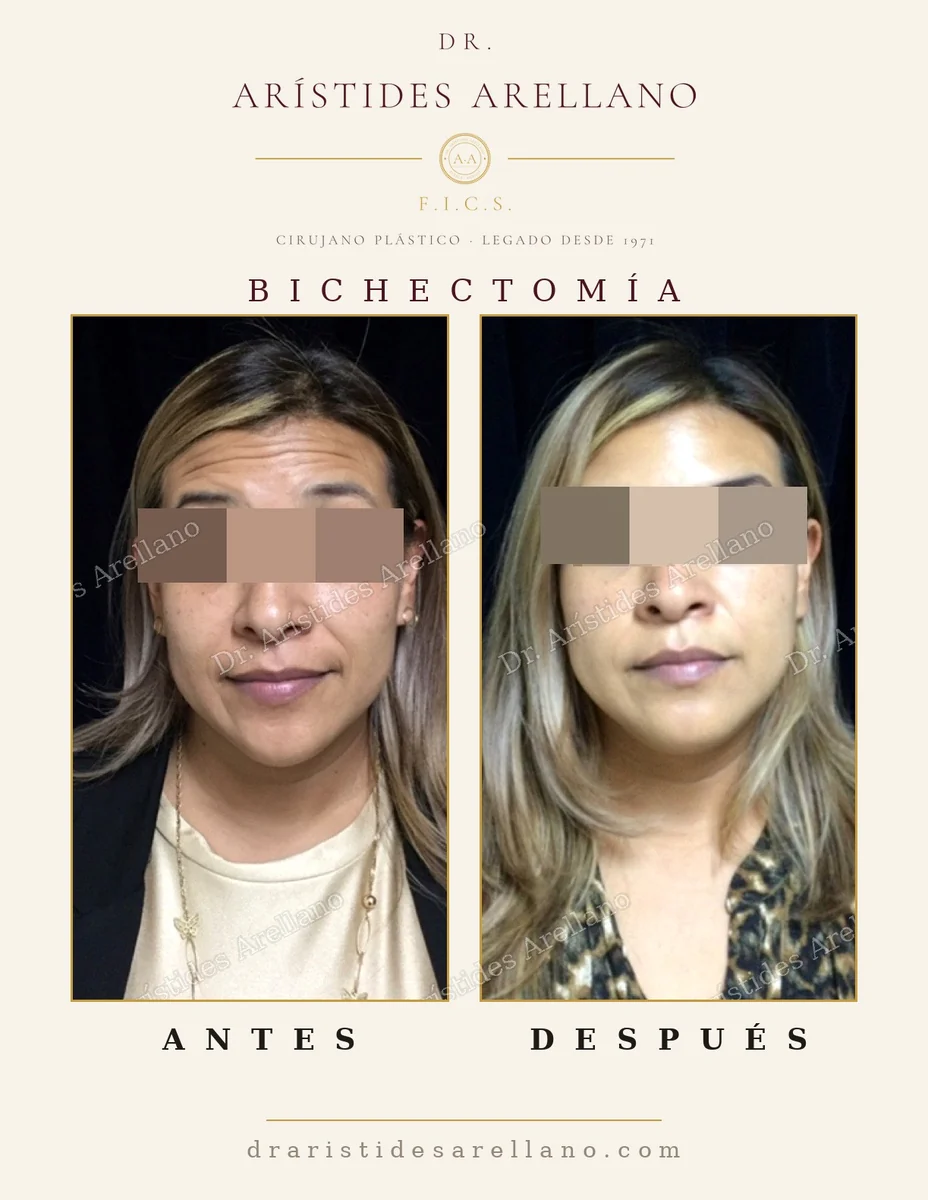 Bichectomía antes y después, definición del contorno facial tras retirar la grasa de la mejilla, cirugía del Dr. Arístides Arellano en Puebla
