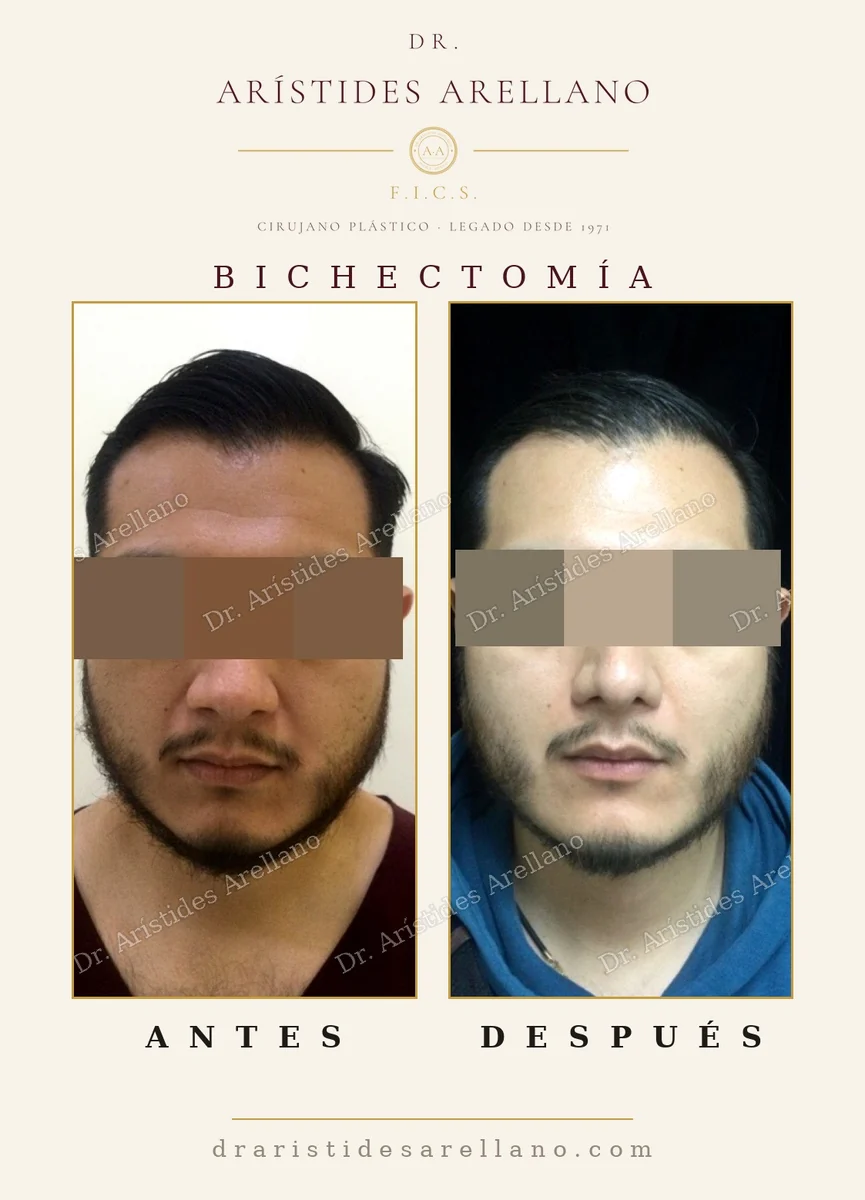 Bichectomía antes y después en vista oblicua, resultado permanente del retiro de las bolas de Bichat, caso del Dr. Arístides Arellano en Puebla