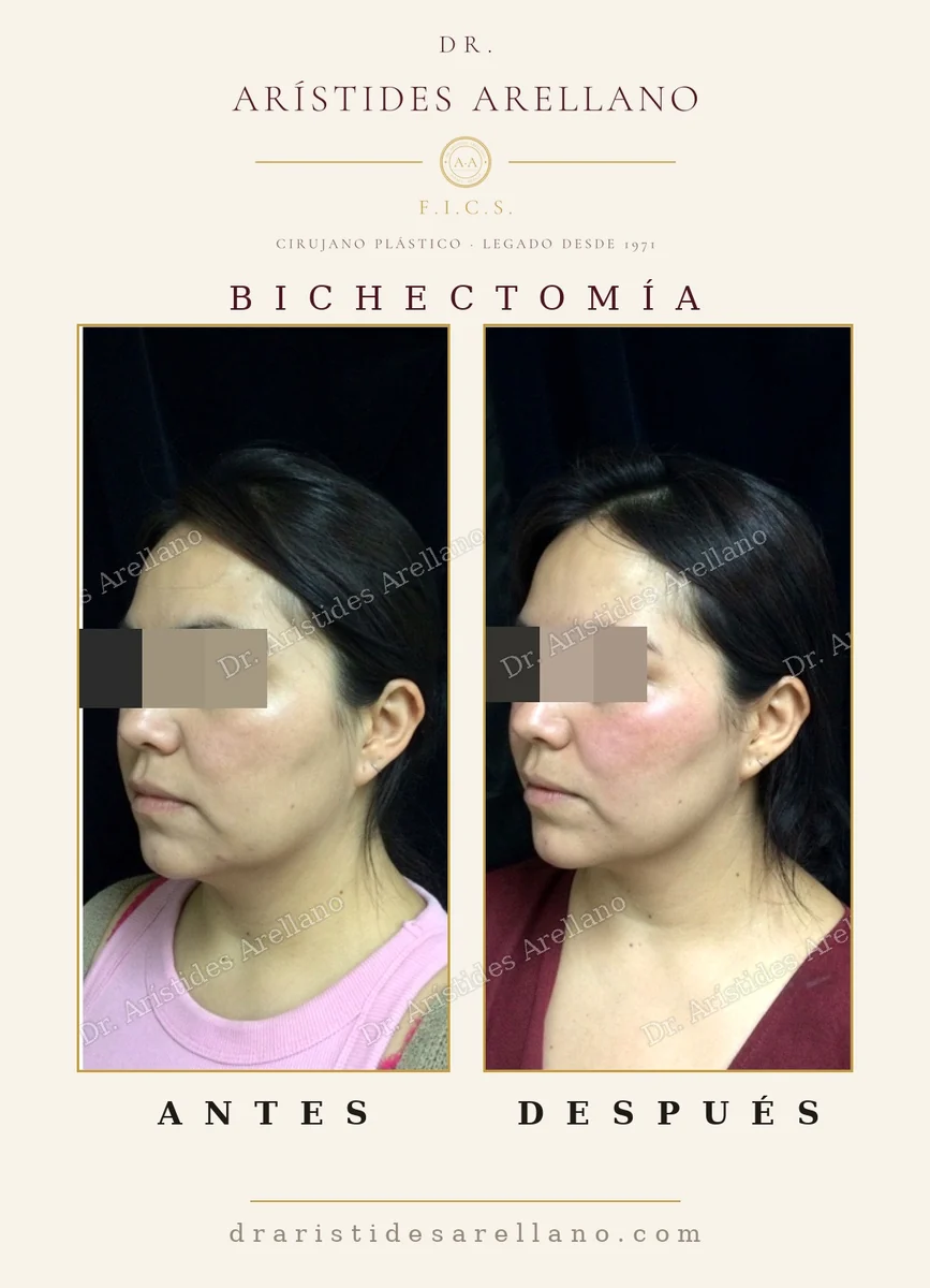 Bichectomía antes y después, evolución de la inflamación tras la cirugía, resultado real del Dr. Arístides Arellano, cirujano plástico en Puebla