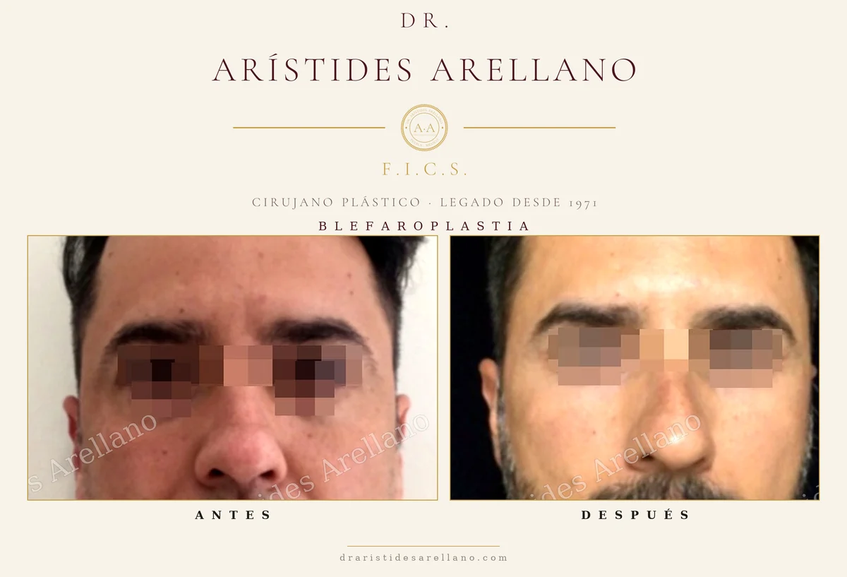 Blefaroplastia antes y después en hombre, vista frontal de la zona de los ojos, cirugía de párpados del Dr. Arístides Arellano, cirujano plástico en Puebla