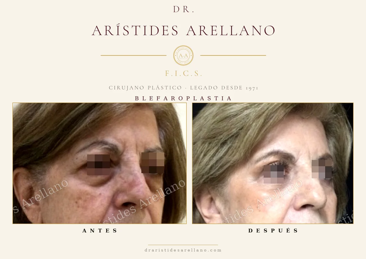 Blefaroplastia antes y después en vista oblicua, evolución de la recuperación de la cirugía de párpados, resultado del Dr. Arístides Arellano en Puebla