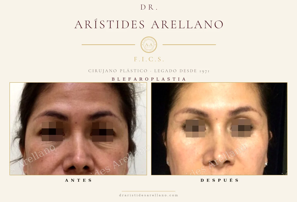 Blefaroplastia antes y después en mujer, vista frontal, corrección de bolsas y piel sobrante en los párpados, caso real del Dr. Arístides Arellano en Puebla