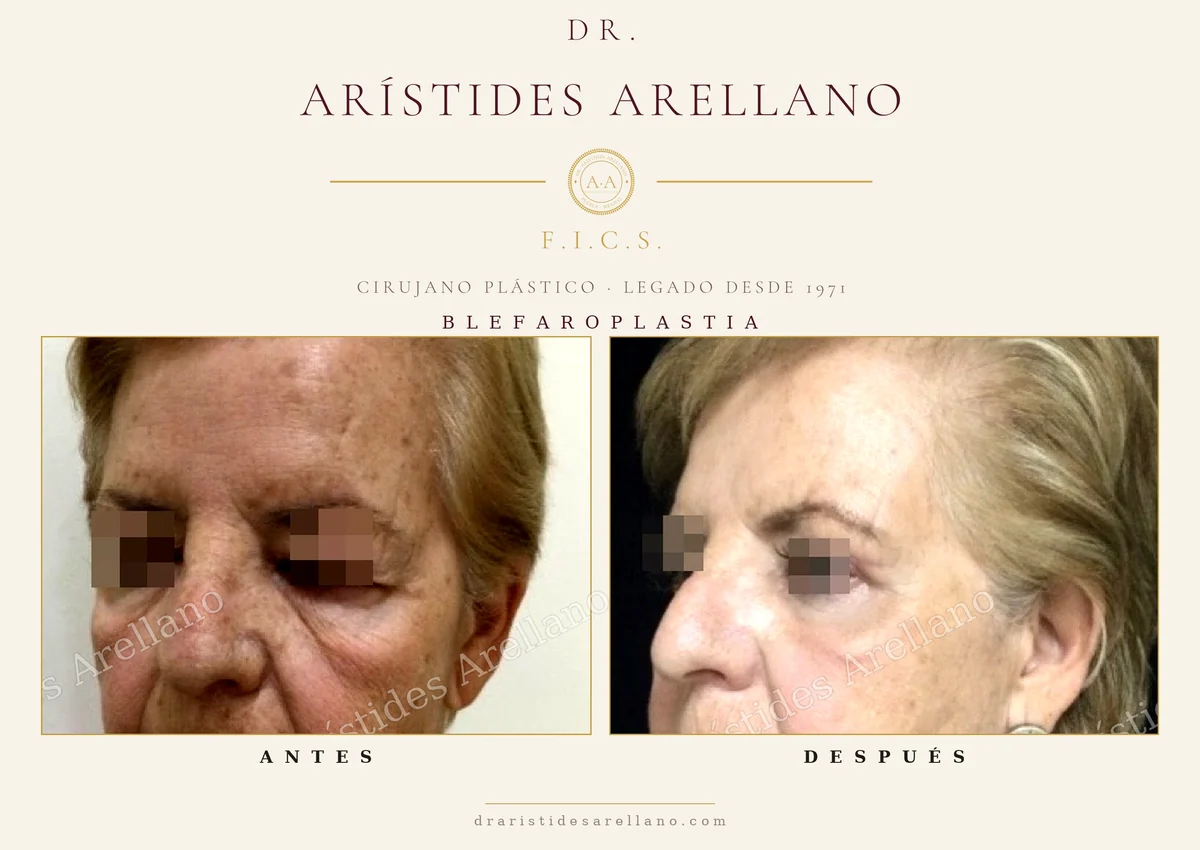 Blefaroplastia antes y después en paciente mayor, vistas frontal y de perfil, corrección de párpados caídos, cirugía del Dr. Arístides Arellano, cirujano plástico en Puebla