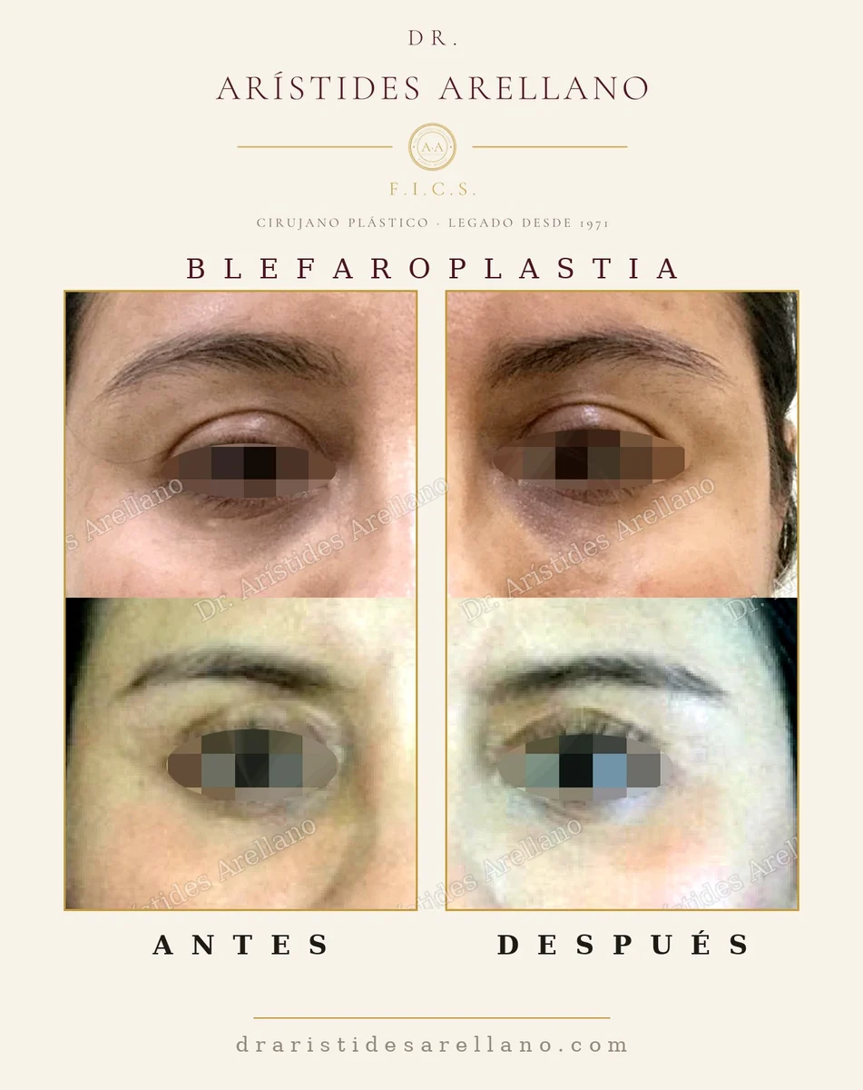 Blefaroplastia inferior antes y después, primer plano de la zona de los ojos, eliminación de las bolsas, resultado real del Dr. Arístides Arellano en Puebla