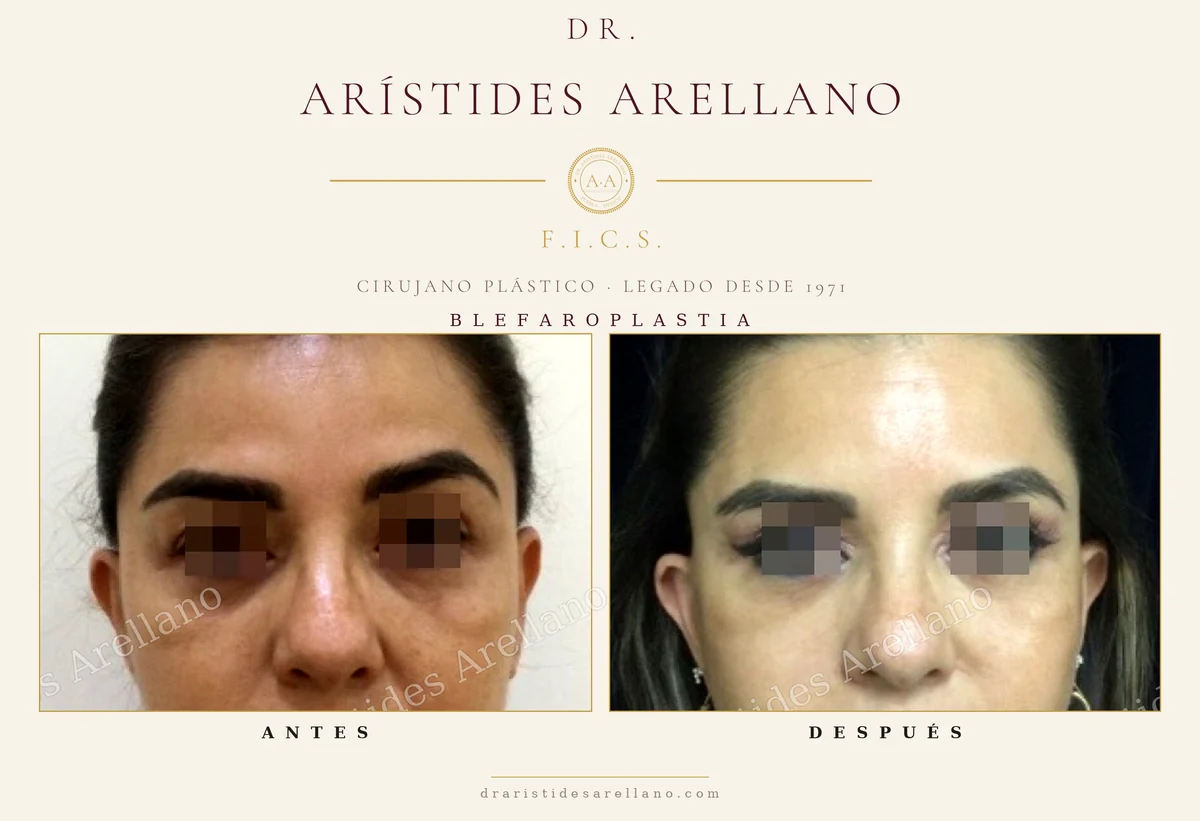 Blefaroplastia antes y después, vista frontal, ubicación de la cicatriz en el pliegue del párpado, cirugía de párpados del Dr. Arístides Arellano en Puebla