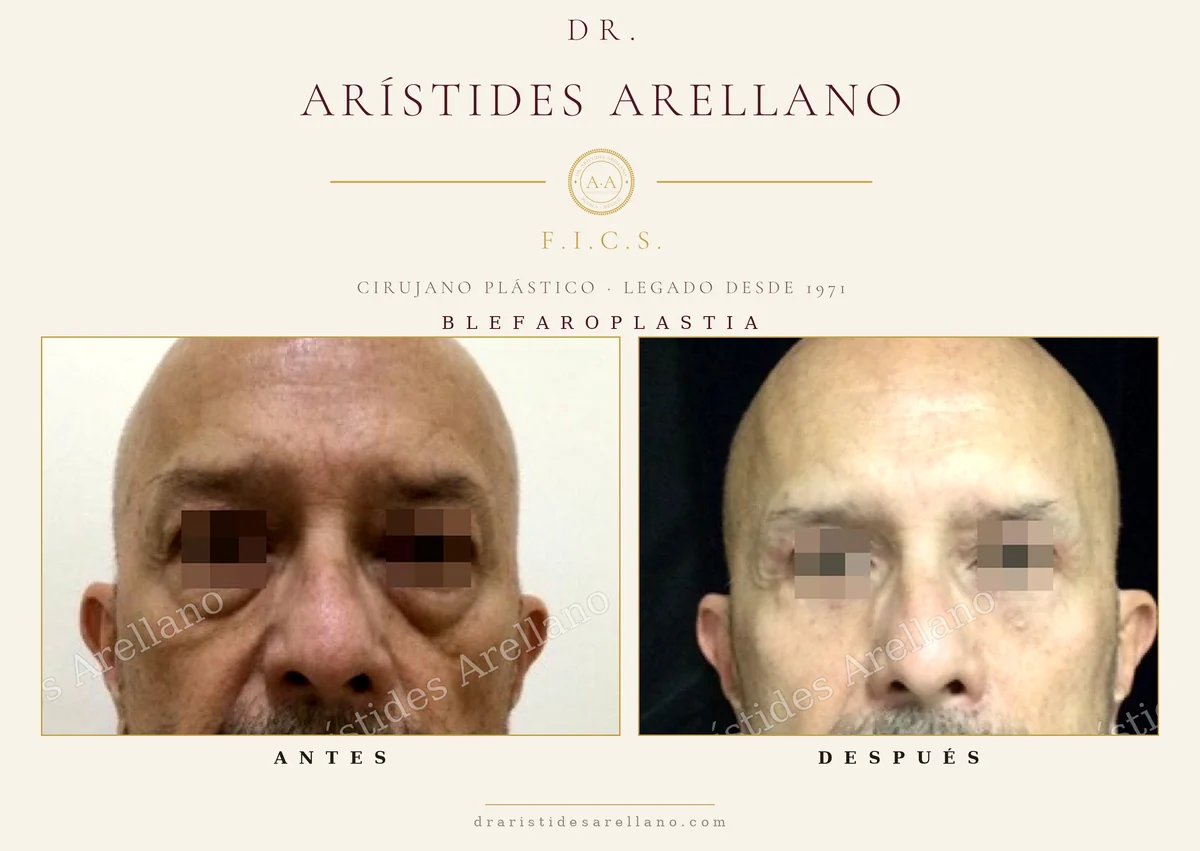 Blefaroplastia masculina antes y después, vista frontal, corrección de párpado superior e inferior en hombre, caso del Dr. Arístides Arellano, cirujano plástico en Puebla