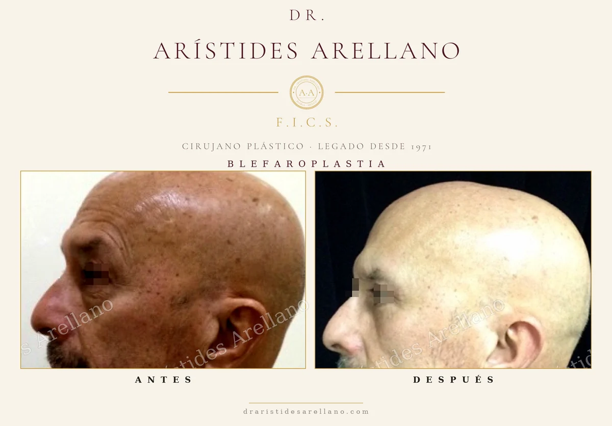 Blefaroplastia antes y después en vista de perfil, diferencia entre párpado superior e inferior, cirugía del Dr. Arístides Arellano en Puebla