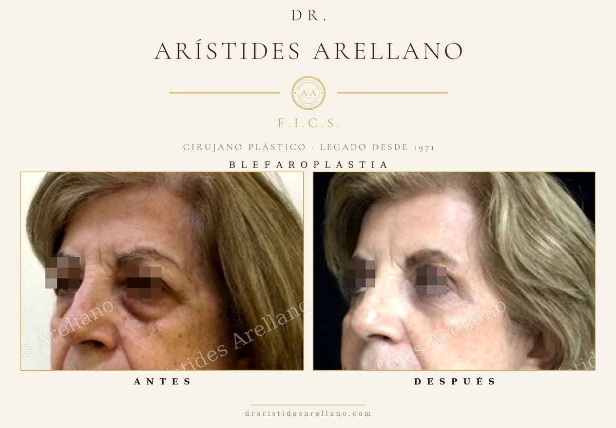 Blefaroplastia antes y después en vista oblicua, duración del resultado en párpados, caso real del Dr. Arístides Arellano, cirujano plástico en Puebla